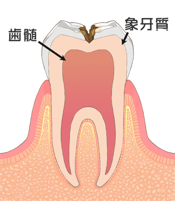 C2［象牙質の虫歯］ 