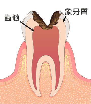 C3［神経の虫歯］ 