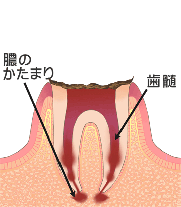 C4［末期の虫歯］ 