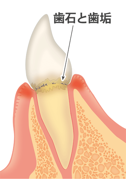 歯周病の進行と治療法