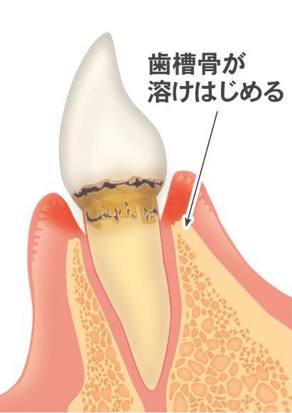 歯周病の進行と治療法