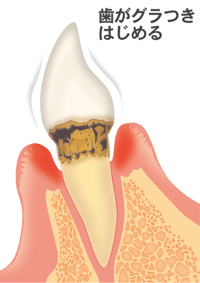 歯周病の進行と治療法