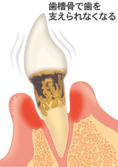 歯周病の進行と治療法