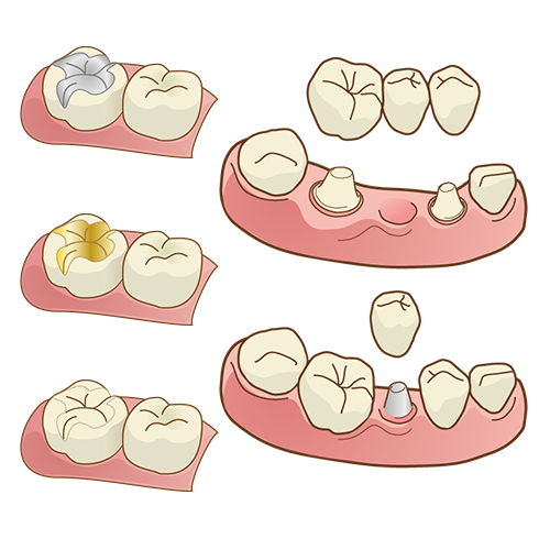 詰め物・かぶせ物について